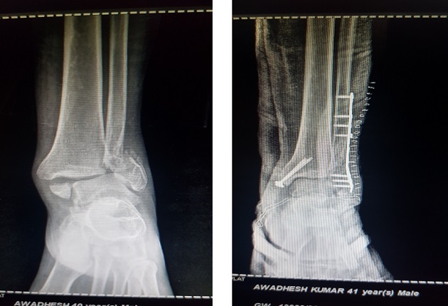INTERVAL MANAGEMENT OF ANKLE FRACTURE