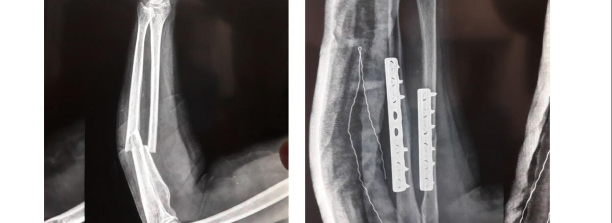 forearm fracture fixation