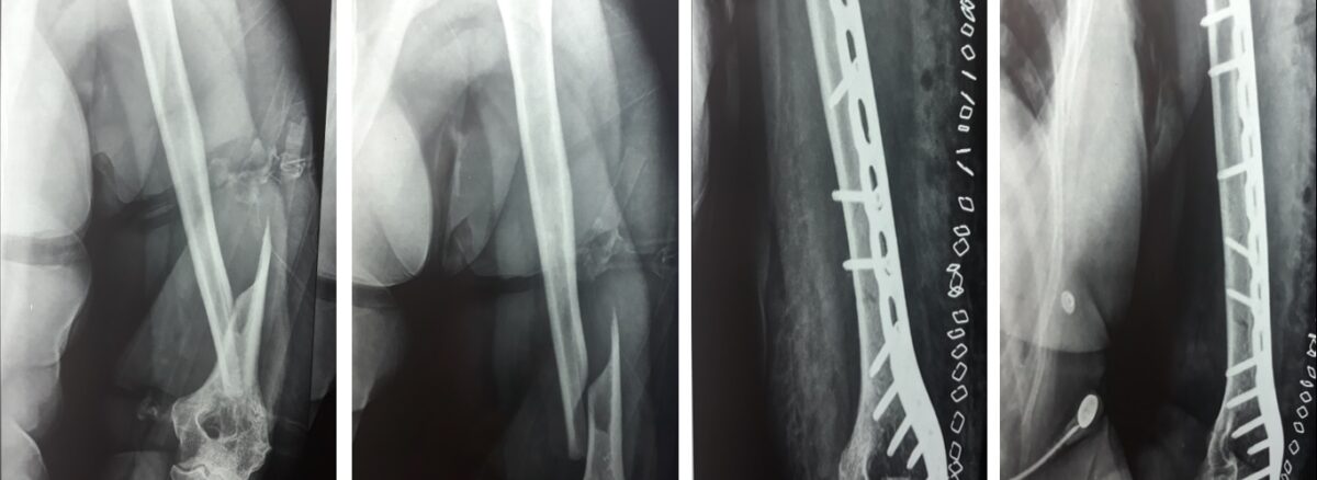 Fracture fixation with new implant design