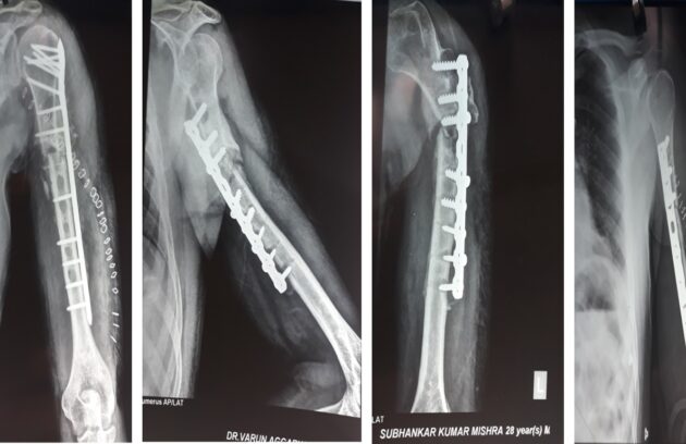 revision fracture surgery