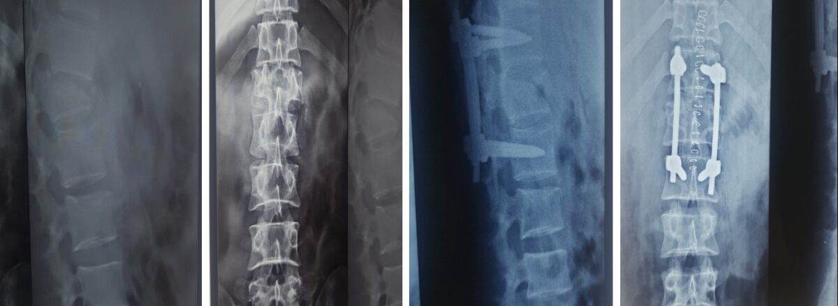 spine fracture fixation