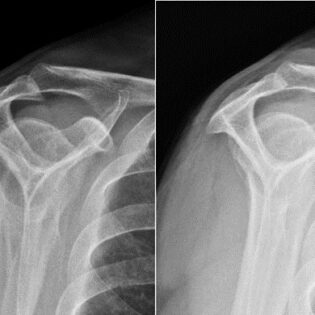 shoulder bones image