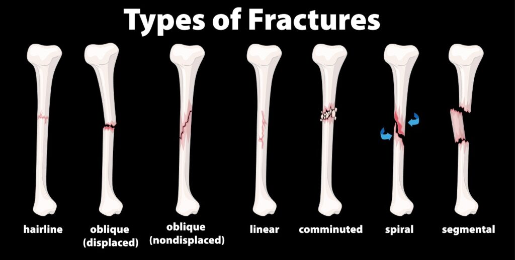 image with types of fractures