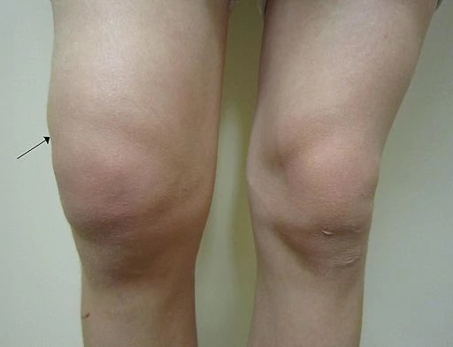 knee-swelling-image