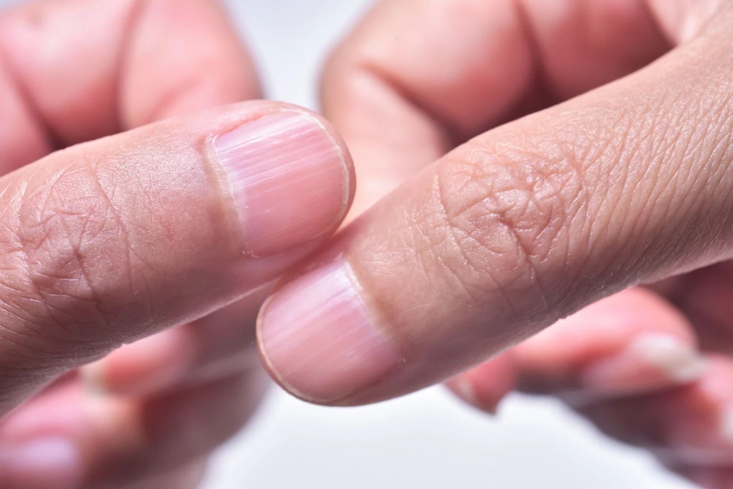 What Causes Peeling Nails — and How to Fix Them