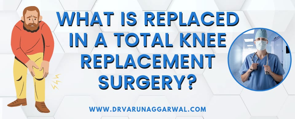 Total Knee Replacement How To Choose The Right Implant