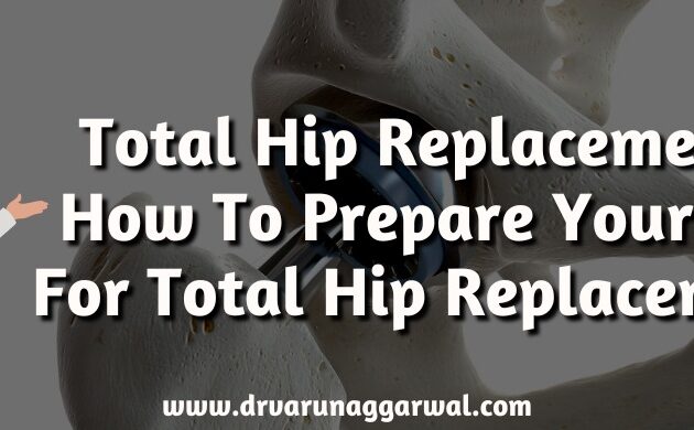 How To Prepare Yourself For Total Hip Replacement
