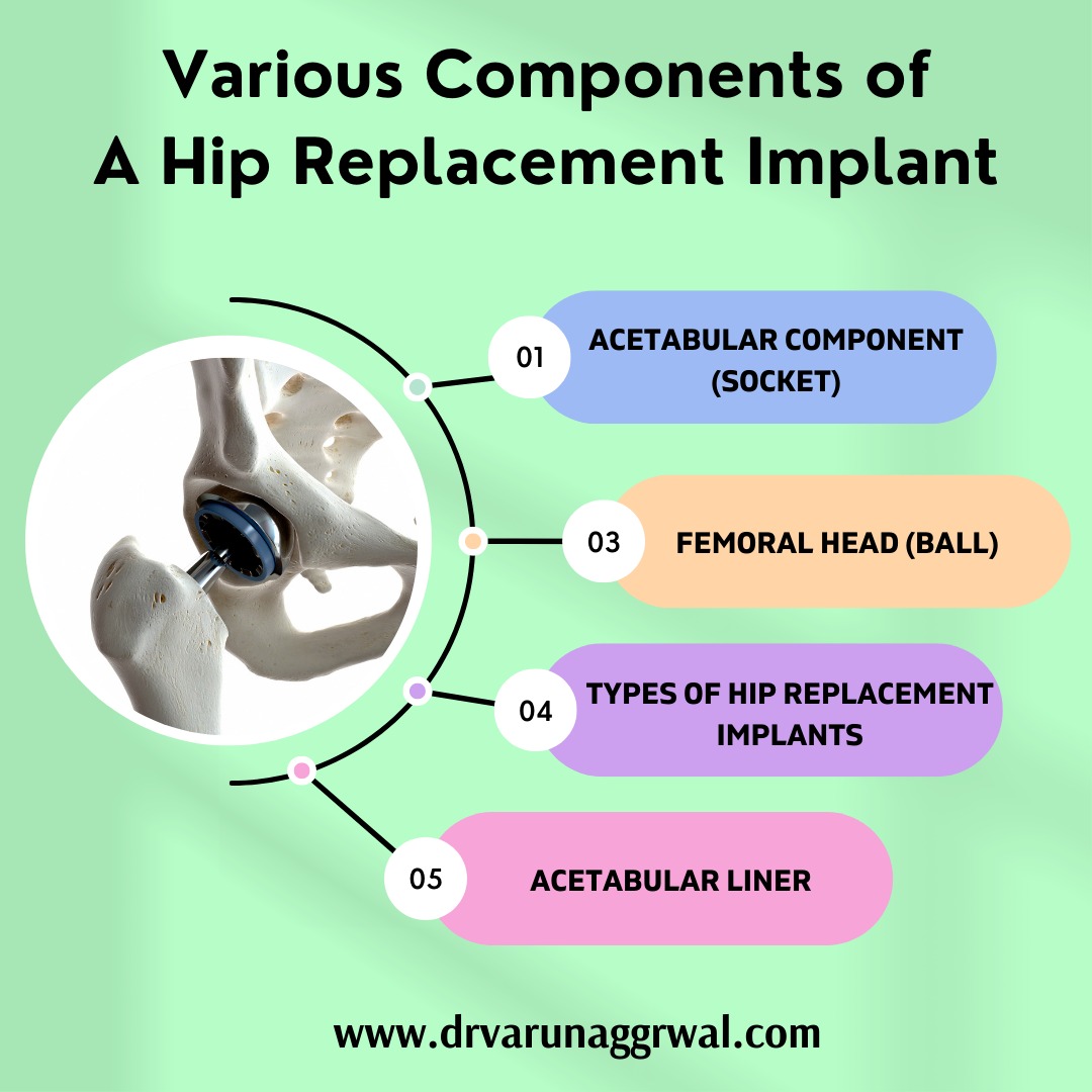 Total Hip Replacement How To Choose The Right Implant Dr Varun Aggarwal 7358