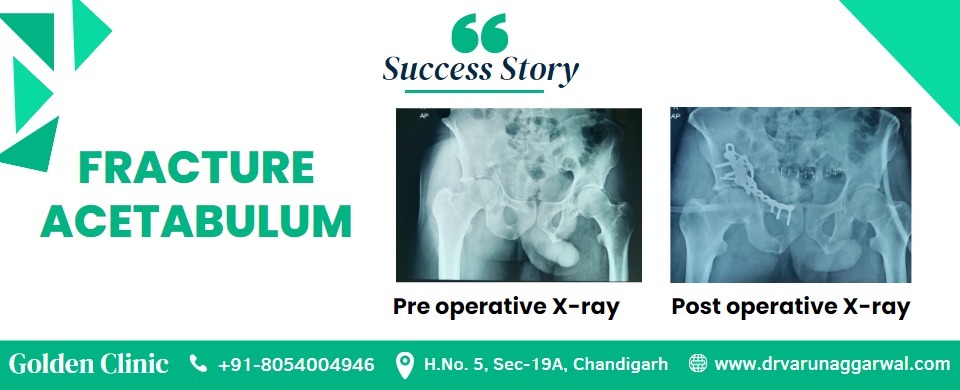 A Remarkable Surgical Success Story of Fracture Acetabulum