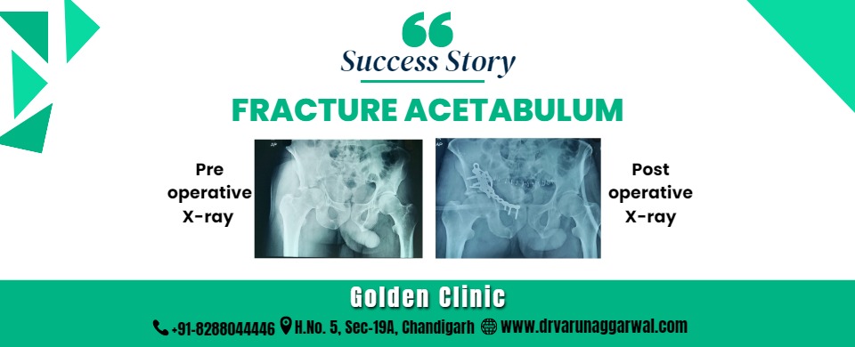 Fracture Acetabulum Success Story