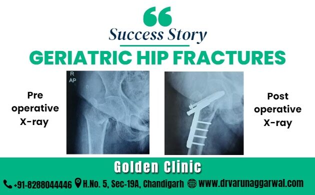 Geriatric hip fractures