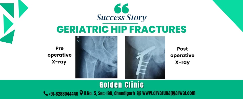 Geriatric hip fractures