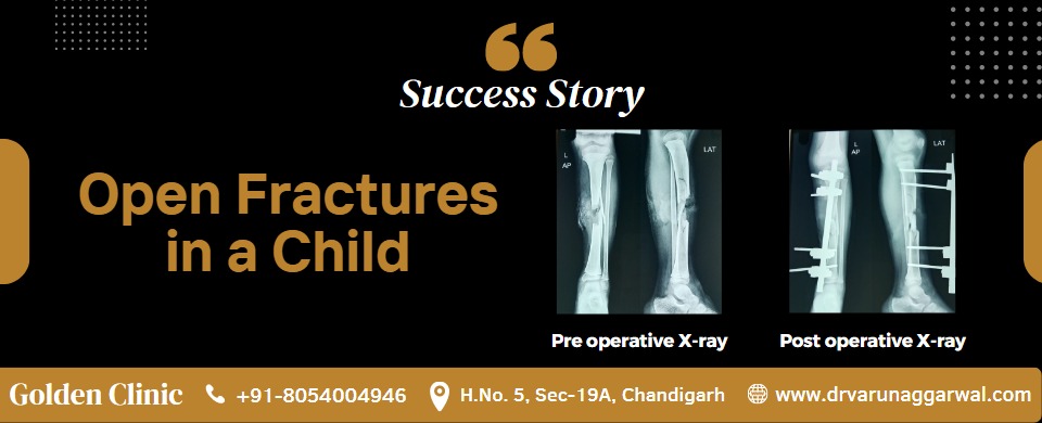 Open-Fracture-in-a-child