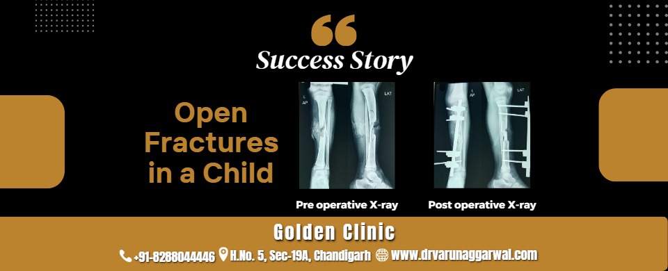 Open Fractures in a Child: A Remarkable Surgical Success Story