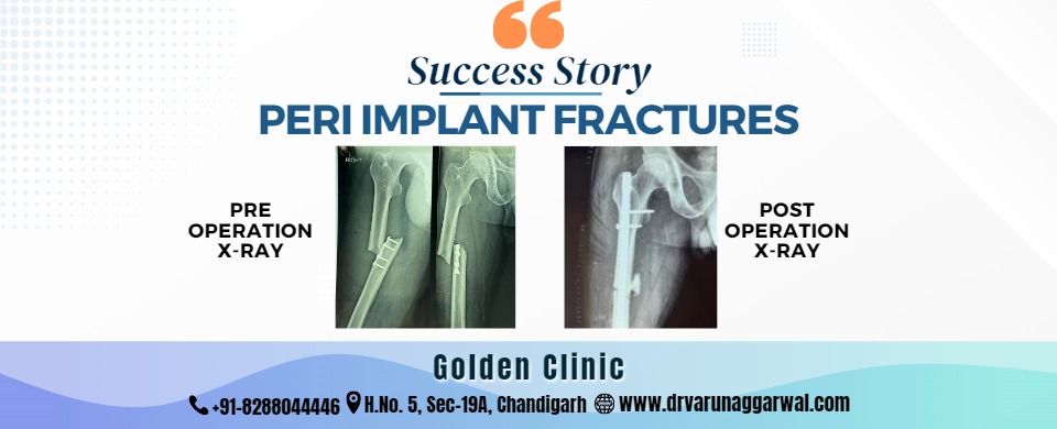 Peri Implant Fractures: A Surgical Success Story