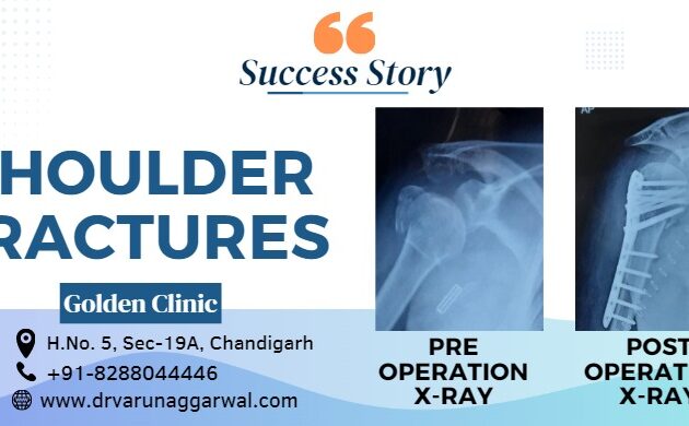 Surgical Success Story: Overcoming Shoulder Fractures