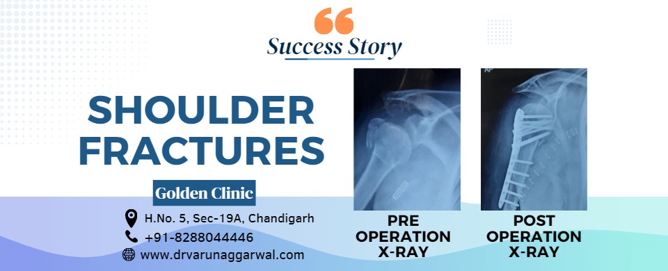 Surgical Success Story: Overcoming Shoulder Fractures