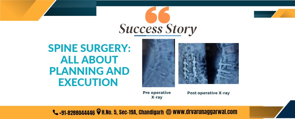 Spine surgery: all about planning and execution