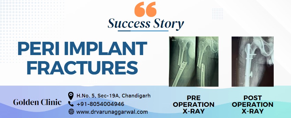 Overcoming Peri-Implant Fractures: A Remarkable Surgical Success Story