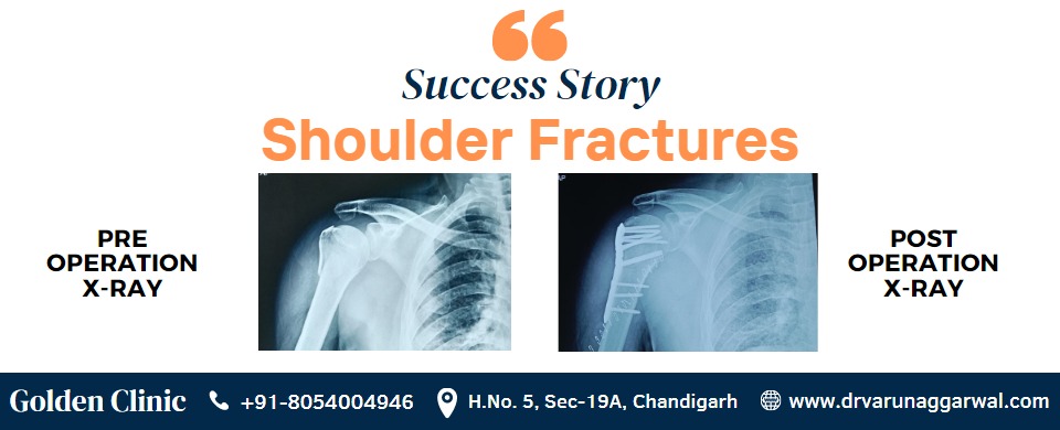 Overcoming a Shoulder Fracture with Dr. Varun Aggarwal