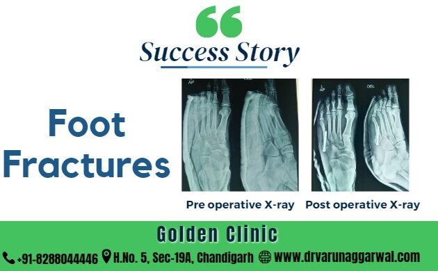 Foot Fractures