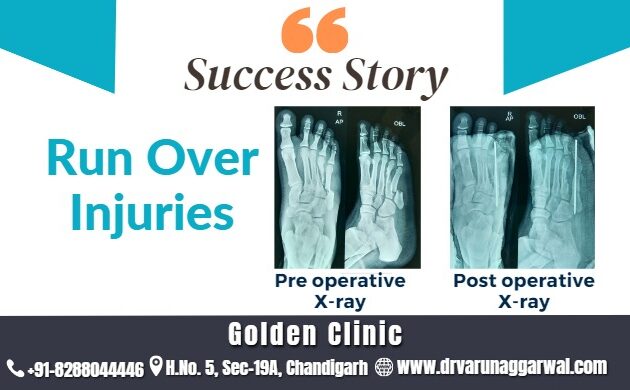Run Over Injuries: A Remarkable Surgical Success Story